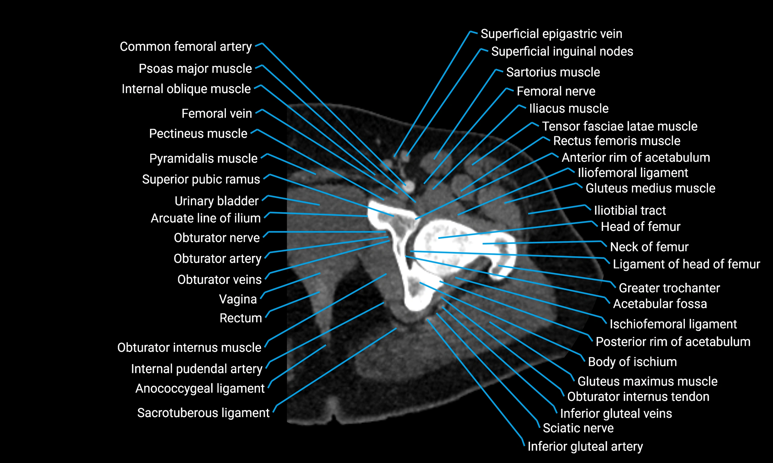 CT lower limb axial cross sectional anatomy labelled image 9 (1).webp